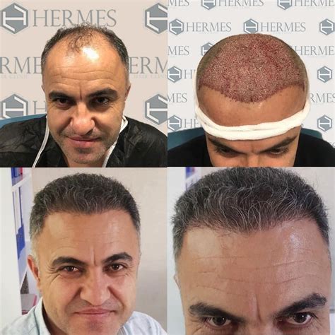 hermes saç ekimi şikayet|Hermest Hair Transplant .